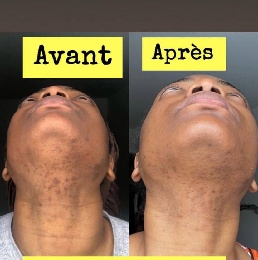 Savon anti - taches au curcuma | 100% Naturel (GB)