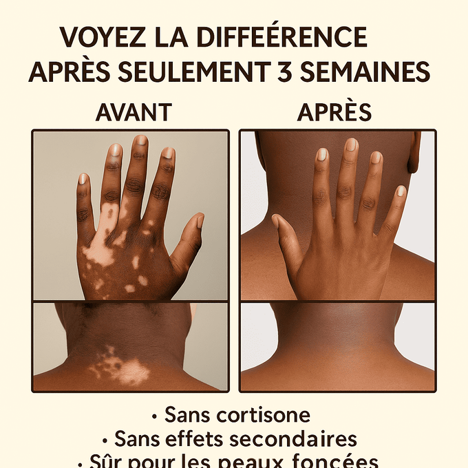 Fini la gêne à cause des taches blanches… Récupérez votre teint naturellement ! - Crème Bee Venom (bn)
