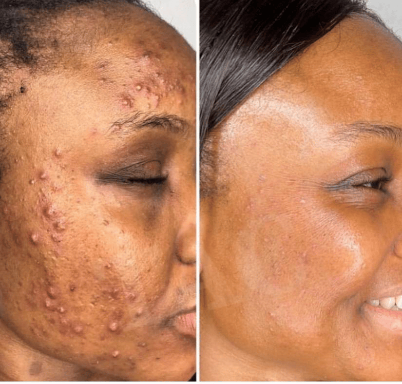 Savon anti - taches au curcuma | 100% Naturel (GB)