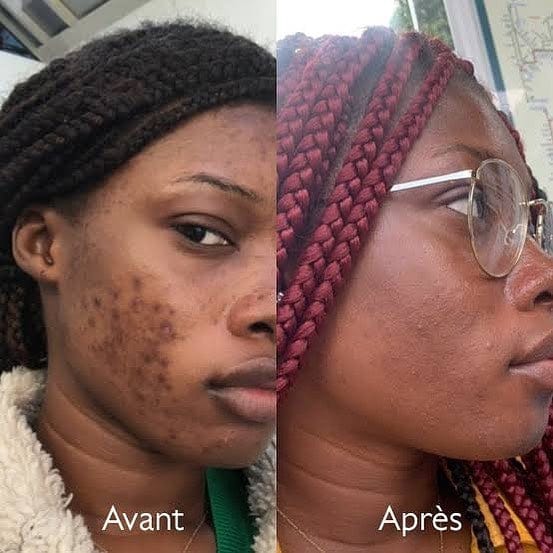 Savon anti - taches au curcuma | 100% Naturel (GB)