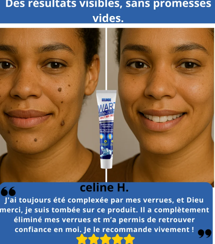 Crème Anti-verrue