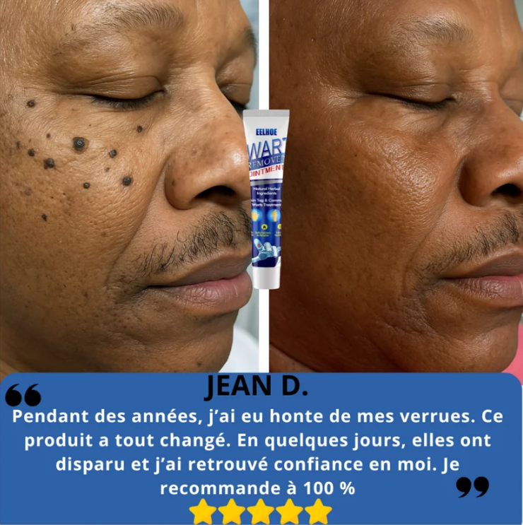 Crème Anti-verrue