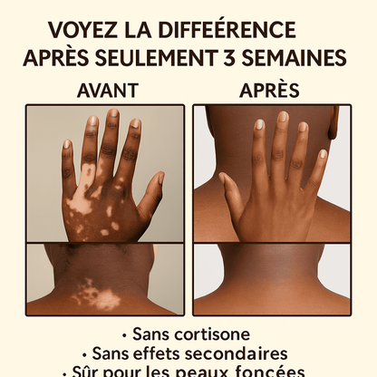 Fini la gêne à cause des taches blanches… Récupérez votre teint naturellement ! - Crème Bee Venom (bn)