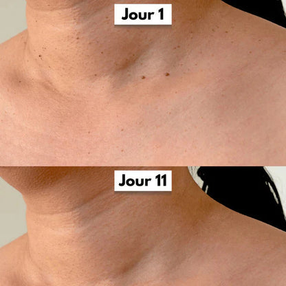 Kit DermaSkin Pro™ – Adieu Les Acrochordons, Résultat Immédiat BN