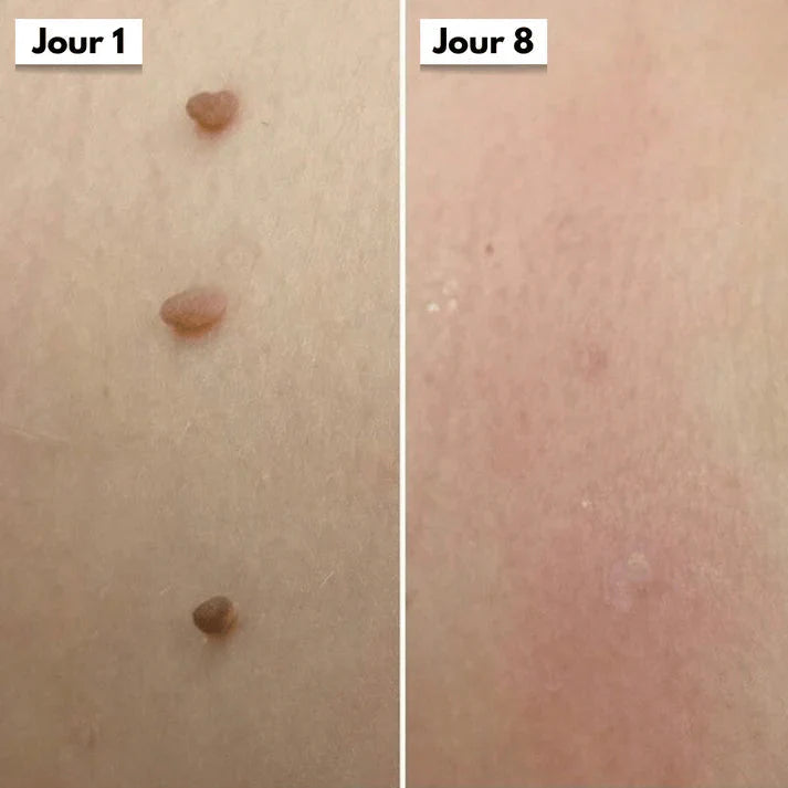 Kit DermaSkin Pro™ – Adieu Les Acrochordons, Résultat Immédiat BN
