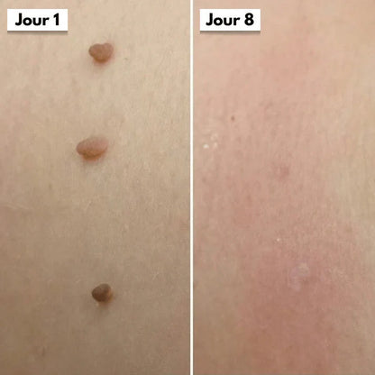 Kit DermaSkin Pro™ – Adieu Les Acrochordons, Résultat Immédiat BN