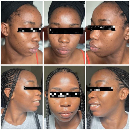 Savon anti - taches au curcuma | 100% Naturel (GB)