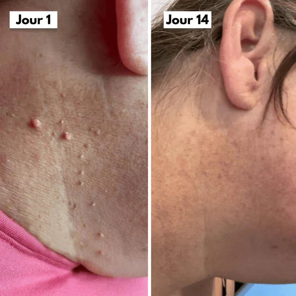 Kit DermaSkin Pro™ – Adieu Les Acrochordons, Résultat Immédiat BN