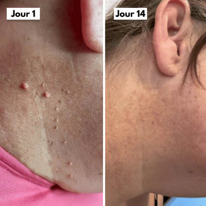 Kit DermaSkin Pro™ – Adieu Les Acrochordons, Résultat Immédiat BN