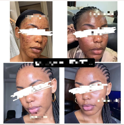 Savon anti - taches au curcuma | 100% Naturel (GB)